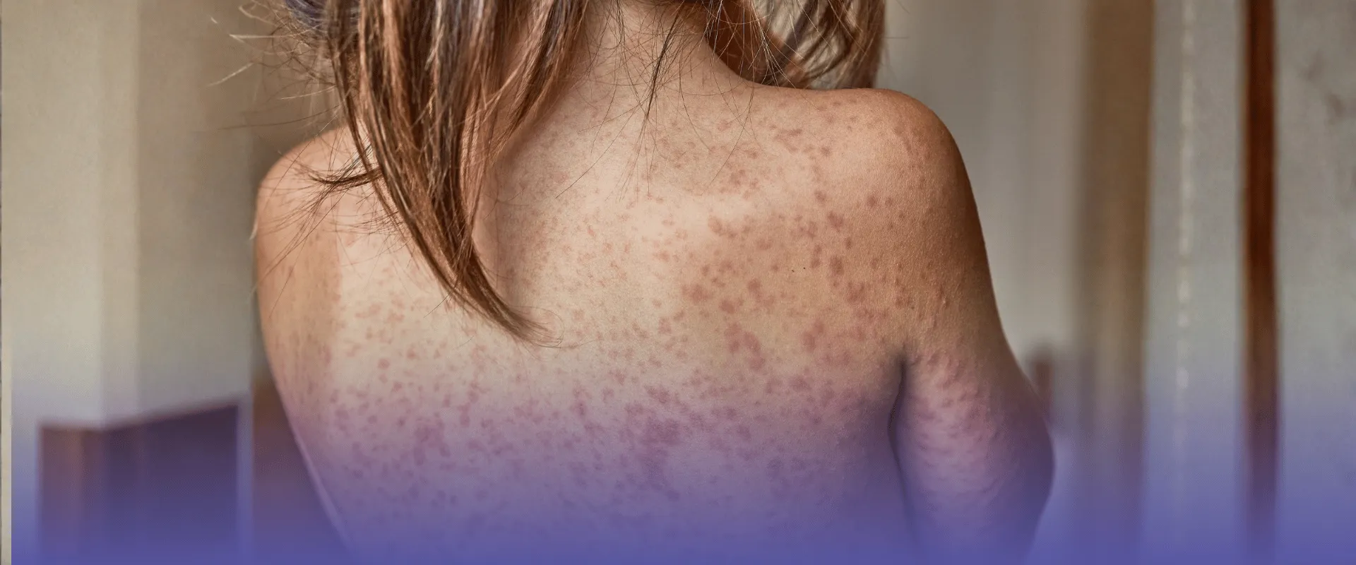 Foto de criança com sintomas de escarlatina