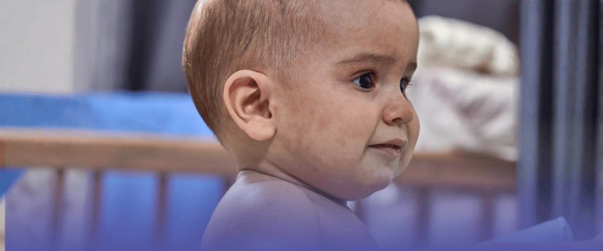 Foto de criança com sintomas de roséola.